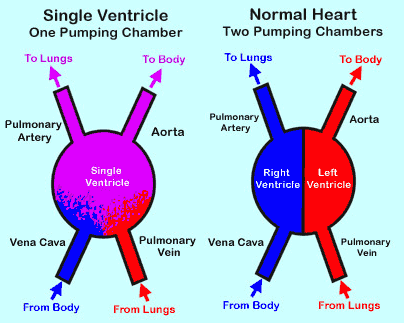 Single Ventricle